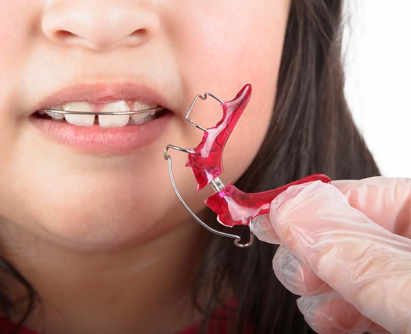 Retainers at Rebel Smiles Orthodontics