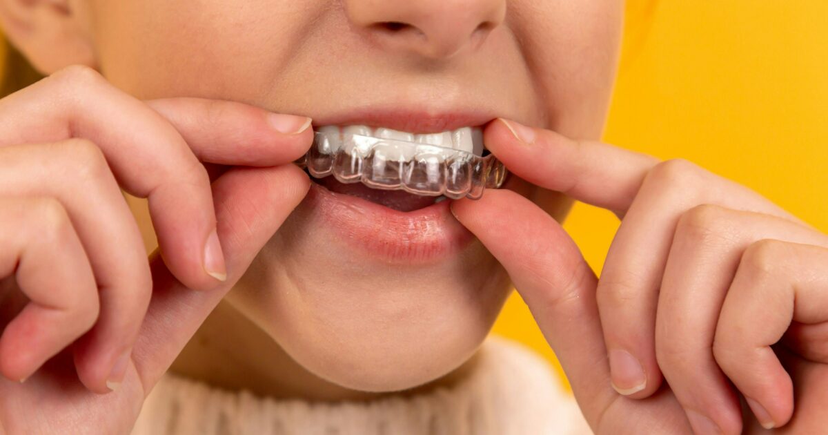 Invisalign with Rebel Smiles Orthodontics