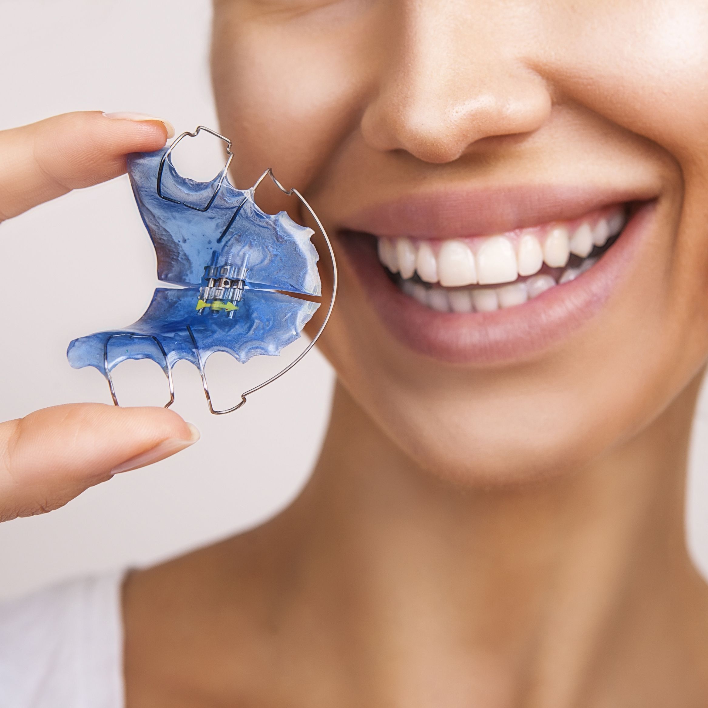 Retainers at Rebel Smiles Orthodontics